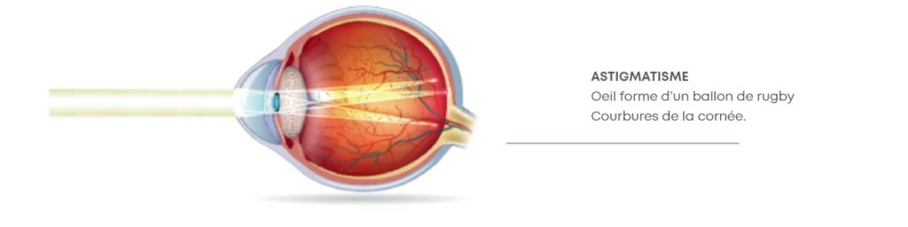 Schéma oeil astigmatisme